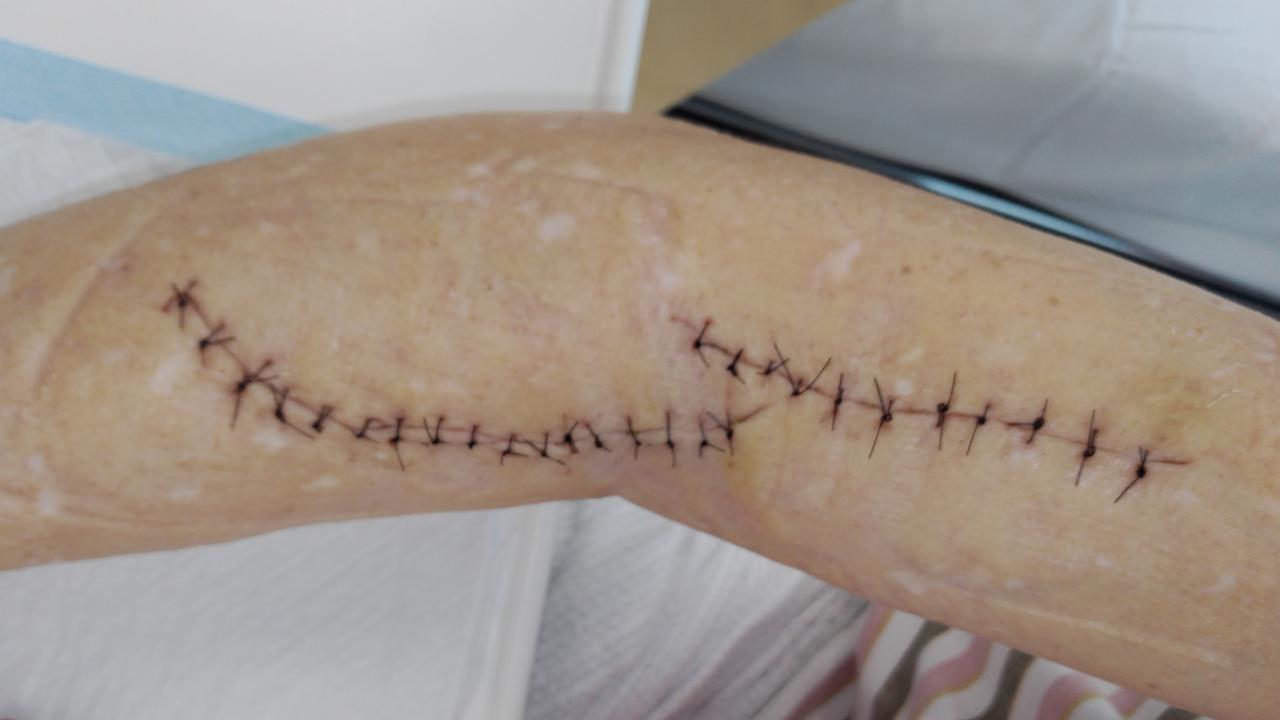 Emma Larnach's injuries after she was stabbed