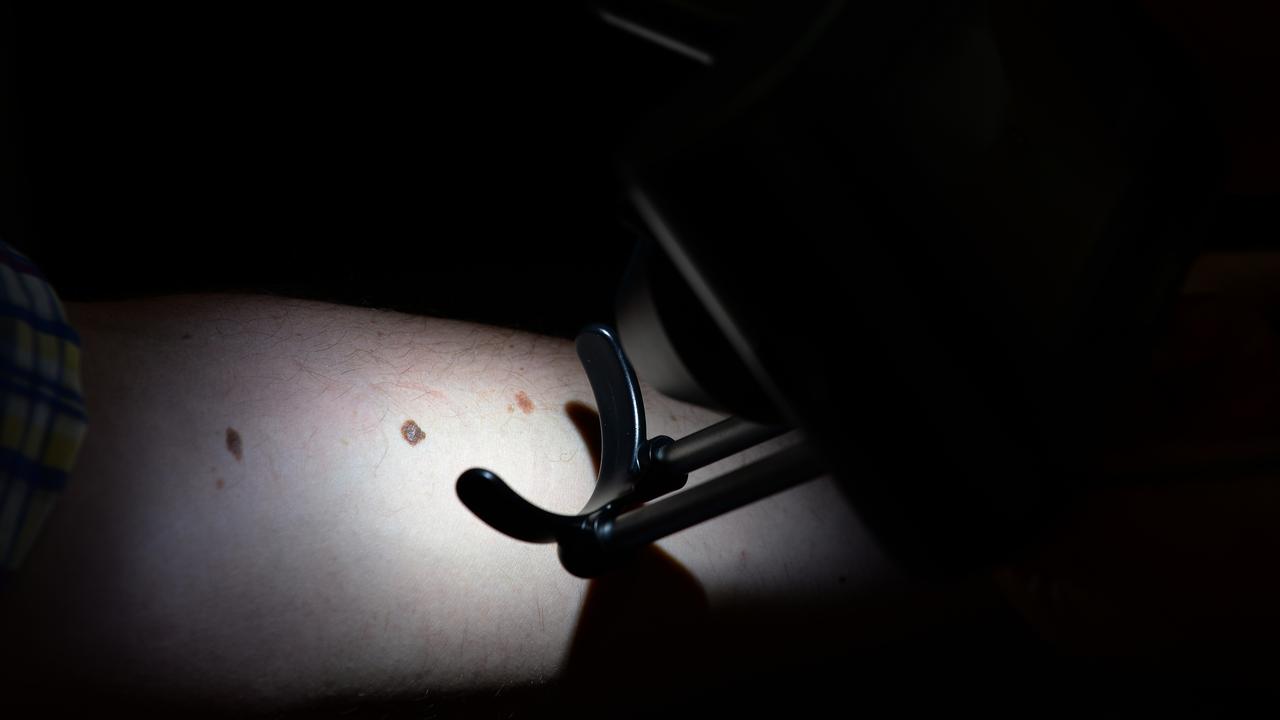 Skin cancer (file)